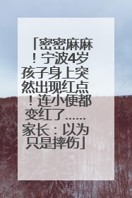 密密麻麻！宁波4岁孩子身上突然出现红点！连小便都变红了……家长：以为只是摔伤